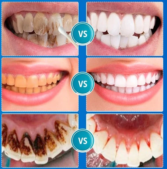 B-care Tanden Bleker – Wittere Tanden – Teeth Whitening Strips – Professioneel Resultaat - Tandsteen Verwijderaar - Zonder Peroxide - Tandenbleekset - Tanden Bleken - Black Friday – Sinterklaas – Schoencadeautjes Sinterklaas 7 B-care Tanden Bleker – Wittere Tanden – Teeth Whitening Strips – Professioneel Resultaat - Tandsteen Verwijderaar - Zonder Peroxide - Tandenbleekset - Tanden Bleken - Black Friday – Sinterklaas – Schoencadeautjes Sinterklaas - Afbeelding 7